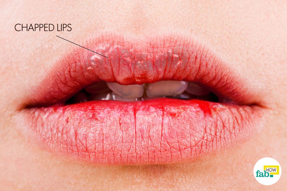 How do you get rid of dry lips?