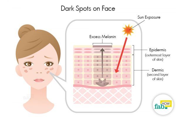 dark spots on face 