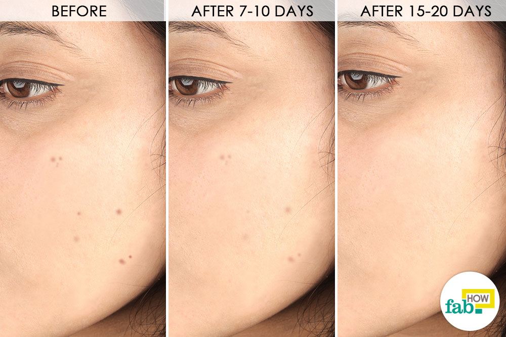 How To Permanently Get Rid Of Dark Spots On Face