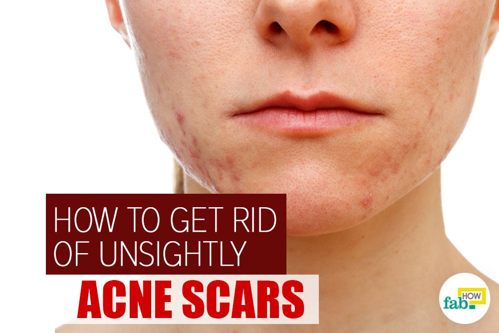 6 Home Remedies to Get Rid of Acne Scars Fast Fab How