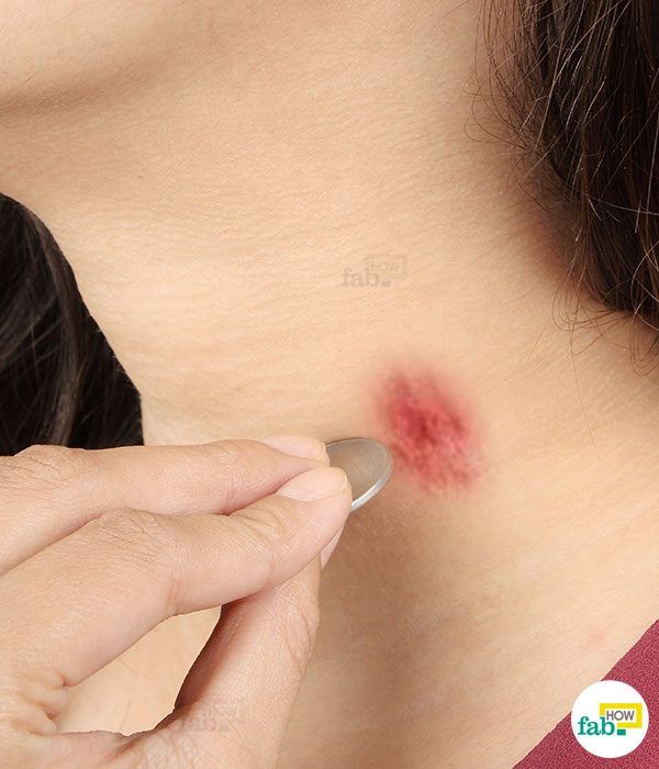 coin to get rid of hickey
