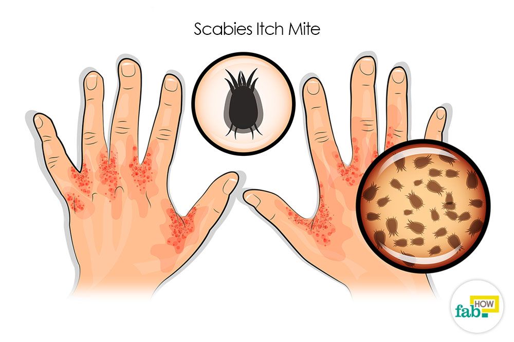 Image result for scabies