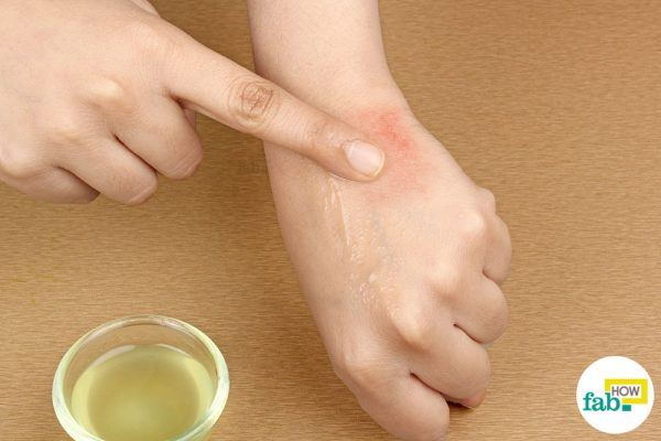 aloe vera for rashes