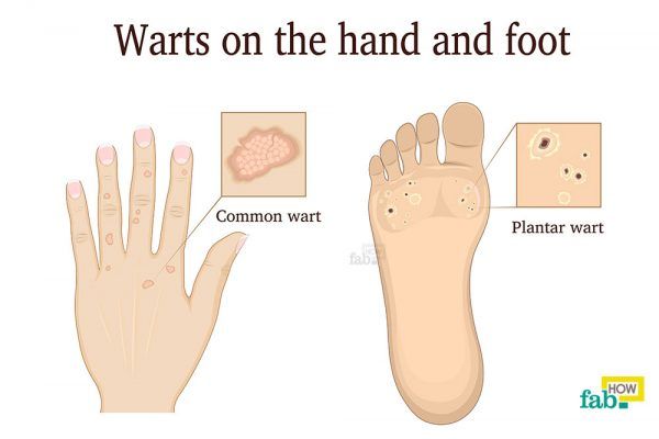 get rid of warts