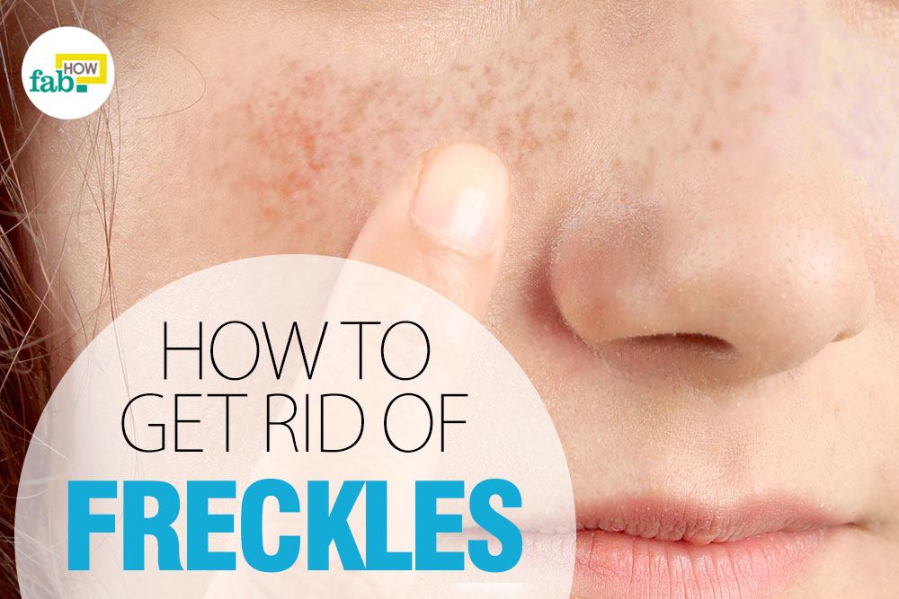get rid of freckles