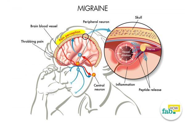 get rid of migraine