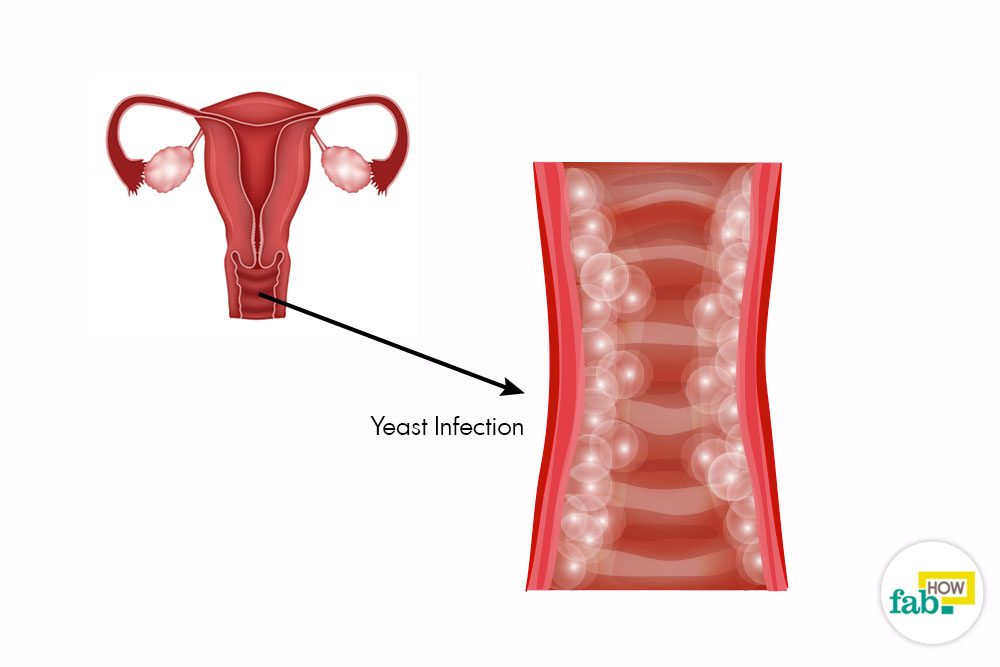How to Get Rid of a Yeast Infection and Get Immediate ...