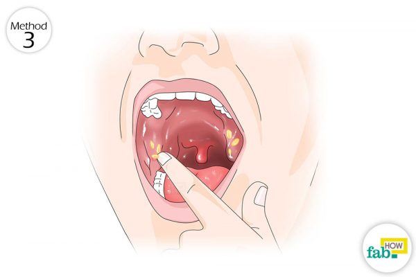 finger to remove tonsil stones