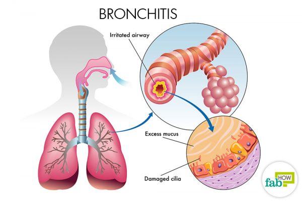 bronchitis 
