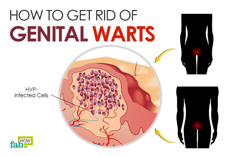 how to get rid of genital warts
