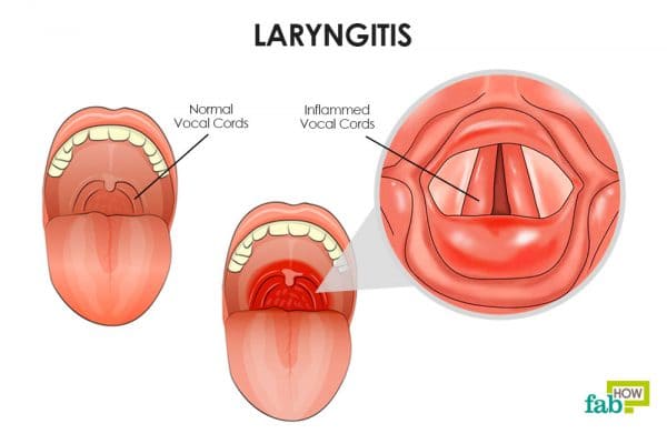 how to get rid of laryngitis