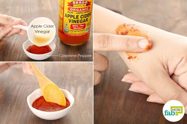 Prepare and apply a mixture of cayenne pepper and apple cider vinegar for pain relief