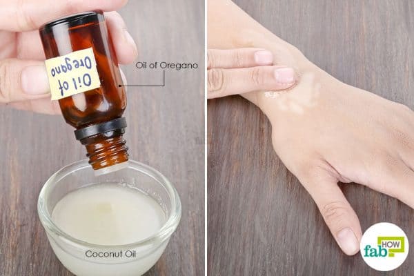 Add oil of oregano to coconut oil and apply to treat vitiligo