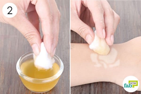 Dab the diluted vinegar on the patches to treat vitiligo