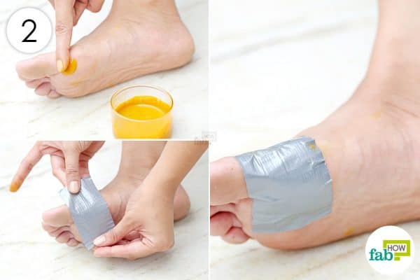 Use turmeric for health-apply the prepared paste on corns and calluses and cover with a bandage