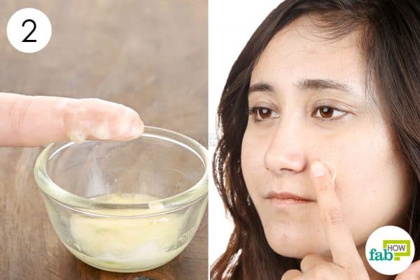 Apply to use baking soda for acne