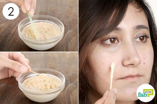 Apply the mix to use baking soda for acne