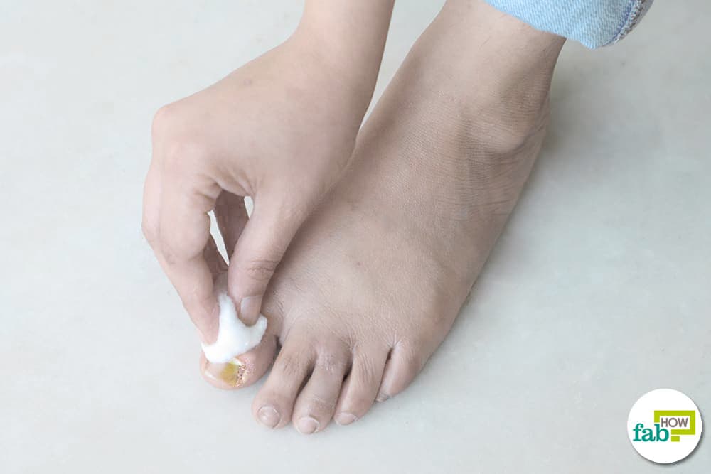 get rid of ingrown toenail